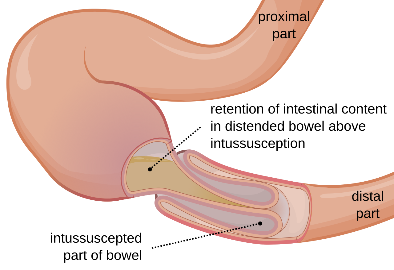 Intussusception_EN.svg